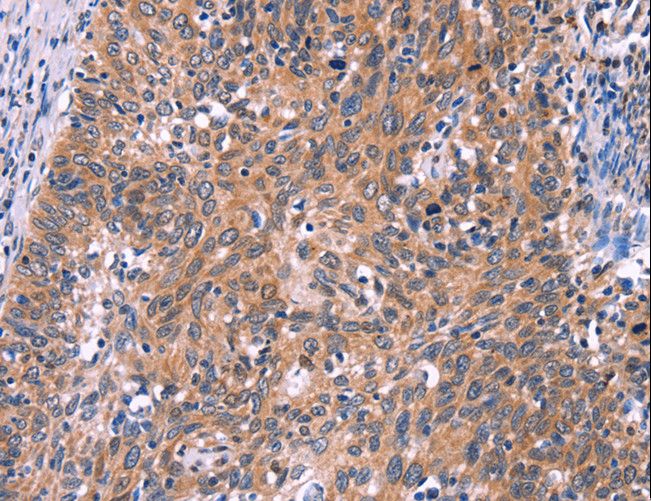 EDN1 / Endothelin 1 Antibody - Immunohistochemistry of paraffin-embedded Human ovarian cancer using EDN1 Polyclonal Antibody at dilution of 1:50.