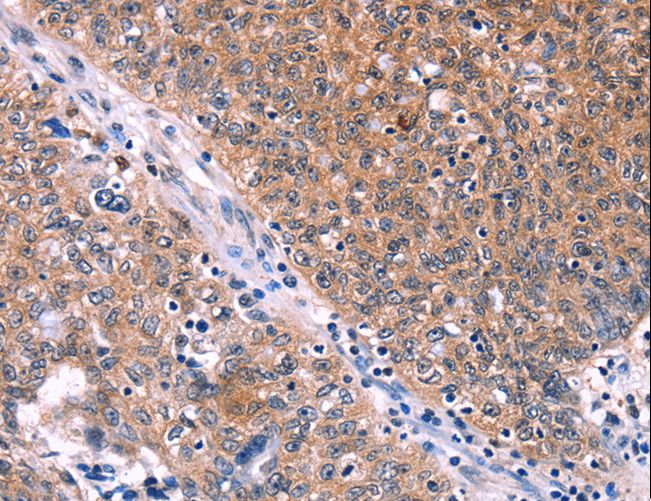 EDN1 / Endothelin 1 Antibody - Immunohistochemistry of paraffin-embedded Human ovarian cancer using EDN1 Polyclonal Antibody at dilution of 1:50.