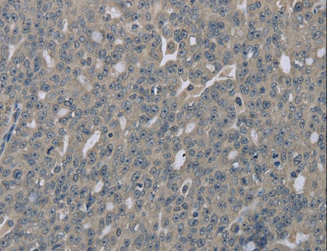 EDN1 / Endothelin 1 Antibody - Immunohistochemistry of paraffin-embedded Human esophagus cancer using EDN1 Polyclonal Antibody at dilution of 1:30.