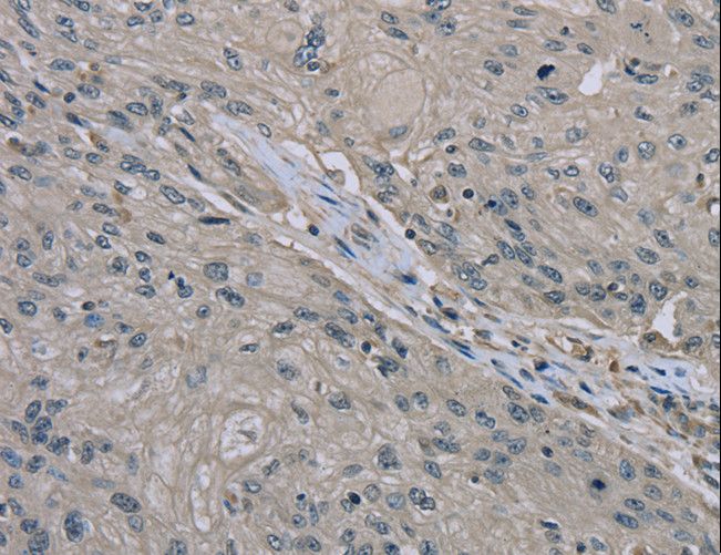 EDN1 / Endothelin 1 Antibody - Immunohistochemistry of paraffin-embedded Human esophagus cancer using EDN1 Polyclonal Antibody at dilution of 1:30.