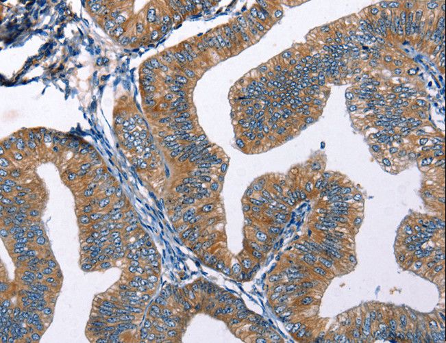 EDN2 / Endothelin 2 Antibody - Immunohistochemistry of paraffin-embedded Human cervical cancer using EDN2 Polyclonal Antibody at dilution of 1:50.