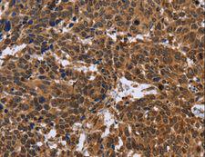 EDN2 / Endothelin 2 Antibody - Immunohistochemistry of paraffin-embedded Human cervical cancer using EDN2 Polyclonal Antibody at dilution of 1:30.