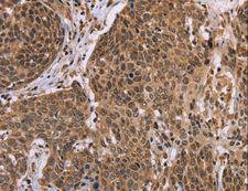 EDN2 / Endothelin 2 Antibody - Immunohistochemistry of paraffin-embedded Human colon cancer using EDN2 Polyclonal Antibody at dilution of 1:30.