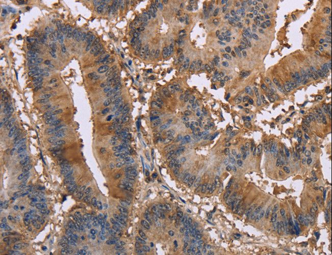 EDN2 / Endothelin 2 Antibody - Immunohistochemistry of paraffin-embedded Human colon cancer using EDN2 Polyclonal Antibody at dilution of 1:30.