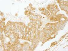 EEA1 Antibody - Detection of Human EEA1 Immunohistochemistry. Sample: FFPE section of human ovarian carcinoma. Antibody: Affinity purified rabbit anti-EEA1 used at a dilution of 1:250.