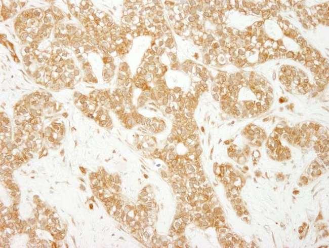 EEA1 Antibody - Detection of Human EEA1 by Immunohistochemistry. Sample: FFPE section of human breast carcinoma. Antibody: Affinity purified rabbit anti-EEA1 used at a dilution of 1:200 (1 Detection: DAB.