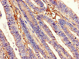 EEA1 Antibody - Immunohistochemistry image of paraffin-embedded human colon cancer at a dilution of 1:100