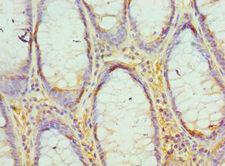 EED Antibody - Immunohistochemistry of paraffin-embedded human colon cancer using antibody 1:100 dilution.