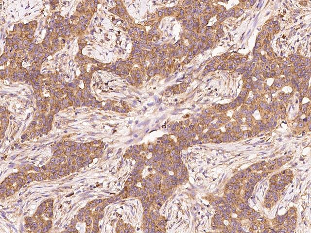 EEF1A1 Antibody - Immunochemical staining of human EEF1A1 in human breast carcinoma with rabbit polyclonal antibody at 1:500 dilution, formalin-fixed paraffin embedded sections.