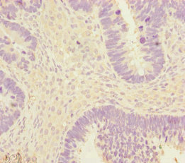 EEF1A2 Antibody - Immunohistochemistry of paraffin-embedded human ovarian cancer at dilution of 1:100