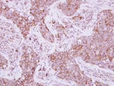 EEF1D Antibody - IHC of paraffin-embedded AdCA, using EEF1D antibody at 1:250 dilution.