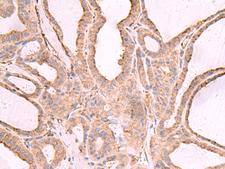 EEF1D Antibody - Immunohistochemistry of paraffin-embedded Human thyroid cancer tissue  using EEF1D Polyclonal Antibody at dilution of 1:65(×200)