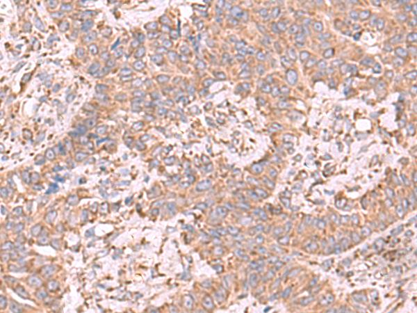 EEF1D Antibody - Immunohistochemistry of paraffin-embedded Human ovarian cancer tissue  using EEF1D Polyclonal Antibody at dilution of 1:65(×200)