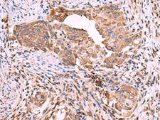 EEF1D Antibody - Immunohistochemistry of paraffin-embedded Human cervical cancer tissue  using EEF1D Polyclonal Antibody at dilution of 1:55(×200)