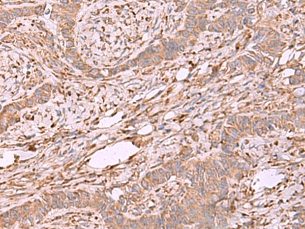 EEF1D Antibody - Immunohistochemistry of paraffin-embedded Human ovarian cancer tissue  using EEF1D Polyclonal Antibody at dilution of 1:55(×200)