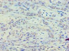 EEF1E1 / AIMP3 Antibody - Immunohistochemistry of paraffin-embedded human breast cancer using antibody at 1:100 dilution.  This image was taken for the unconjugated form of this product. Other forms have not been tested.