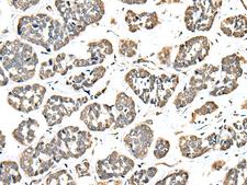 EEF1E1 / AIMP3 Antibody - Immunohistochemistry of paraffin-embedded Human esophagus cancer tissue  using EEF1E1 Polyclonal Antibody at dilution of 1:35(×200)