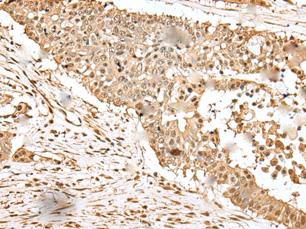 EEF1E1 / AIMP3 Antibody - Immunohistochemistry of paraffin-embedded Human colorectal cancer tissue  using EEF1E1 Polyclonal Antibody at dilution of 1:35(×200)