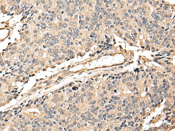 EEF1E1 / AIMP3 Antibody - Immunohistochemistry of paraffin-embedded Human prost at e cancer tissue  using EEF1E1 Polyclonal Antibody at dilution of 1:25(×200)