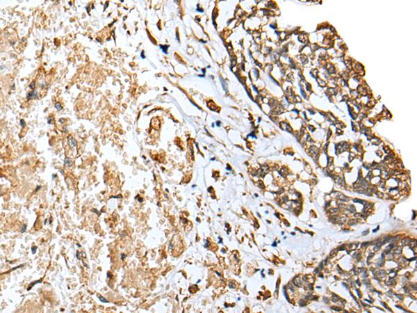 EEF1E1 / AIMP3 Antibody - Immunohistochemistry of paraffin-embedded Human esophagus cancer tissue  using EEF1E1 Polyclonal Antibody at dilution of 1:25(×200)