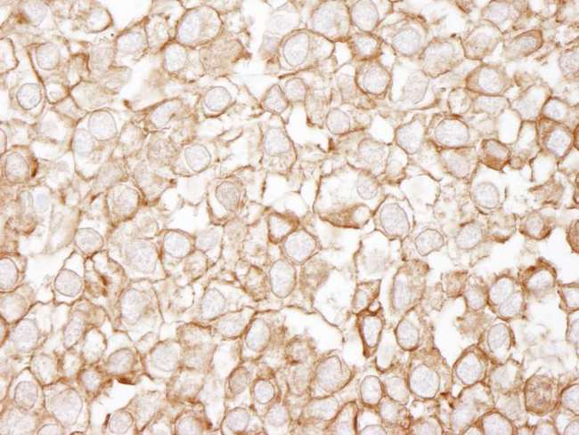 EEF2 / Elongation Factor 2 Antibody - Detection of Human eEF2 by Immunohistochemistry. Sample: FFPE section of human testicular seminoma. Antibody: Affinity purified rabbit anti-eEF2 used at a dilution of 1:100.
