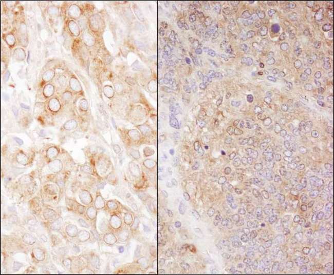 EEF2 / Elongation Factor 2 Antibody - Detection of Human and Mouse eEF2 by Immunohistochemistry. Sample: FFPE section of human breast carcinoma (left) and mouse teratoma (right). Antibody: Affinity purified rabbit anti-eEF2 used at a dilution of 1:1000 (0.2 Detection: DAB.