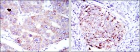 EEF2 / Elongation Factor 2 Antibody - IHC of paraffin-embedded liver cancer tissues (left) and kidney cancer tissues (right) using EEF2 mouse mAb with DAB staining.