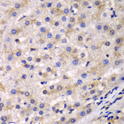 EEF2 / Elongation Factor 2 Antibody - Immunohistochemistry of paraffin-embedded human liver cancer tissue.