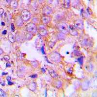 EEF2 / Elongation Factor 2 Antibody - Immunohistochemical analysis of EEF2 (pT56) staining in human lung cancer formalin fixed paraffin embedded tissue section. The section was pre-treated using heat mediated antigen retrieval with sodium citrate buffer (pH 6.0). The section was then incubated with the antibody at room temperature and detected using an HRP conjugated compact polymer system. DAB was used as the chromogen. The section was then counterstained with hematoxylin and mounted with DPX.