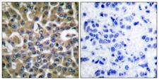 EEF2 / Elongation Factor 2 Antibody - Peptide - + Immunohistochemical analysis of paraffin-embedded human breast carcinoma tissue using eEF2 (Ab-56) antibody.