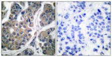 EEF2 / Elongation Factor 2 Antibody - Immunohistochemistry analysis of paraffin-embedded human breast carcinoma, using eEF2 (Phospho-Thr56) Antibody. The picture on the right is blocked with the phospho peptide.