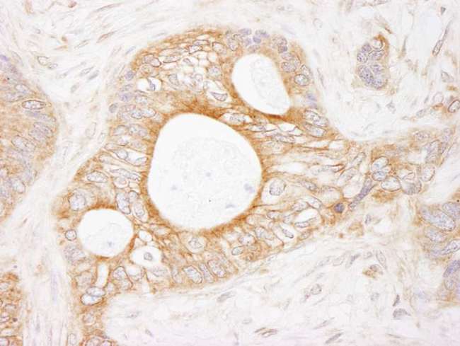 EEF2K Antibody - Detection of Human eEF2 Kinase by Immunohistochemistry. Sample: FFPE section of human ovarian carcinoma. Antibody: Affinity purified rabbit anti-eEF2 Kinase used at a dilution of 1:1000 (1 Detection: DAB.