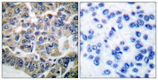 EEF2K Antibody - Immunohistochemistry analysis of paraffin-embedded human breast carcinoma tissue, using eEF2K Antibody. The picture on the right is blocked with the synthesized peptide.