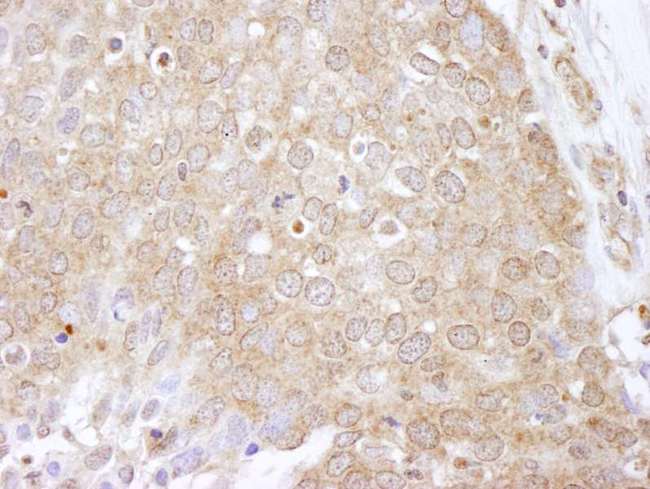 EEF2K Antibody - Detection of Human eEF2 Kinase by Immunohistochemistry. Sample: FFPE section of human breast carcinoma. Antibody: Affinity purified rabbit anti-eEF2 Kinase used at a dilution of 1:250.