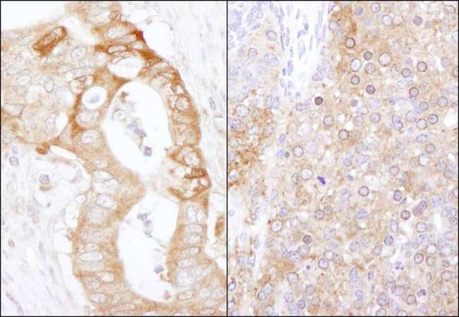 EEF2K Antibody - Detection of Human and Mouse eEF2 Kinase by Immunohistochemistry. Sample: FFPE section of human stomach carcinoma (left) and mouse teratoma (right). Antibody: Affinity purified rabbit anti-eEF2 Kinase used at a dilution of 1:1000 (1 Detection: DAB.