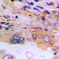EEF2K Antibody - Immunohistochemical analysis of EEF2K staining in human lung cancer formalin fixed paraffin embedded tissue section. The section was pre-treated using heat mediated antigen retrieval with sodium citrate buffer (pH 6.0). The section was then incubated with the antibody at room temperature and detected using an HRP-conjugated compact polymer system. DAB was used as the chromogen. The section was then counterstained with hematoxylin and mounted with DPX.