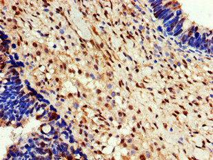 EEF2K Antibody - Immunohistochemistry of paraffin-embedded human ovarian cancer using EEF2K Antibody at dilution of 1:100