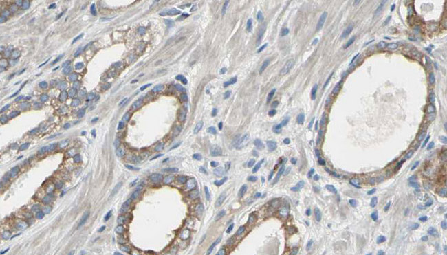 EEF2K Antibody - 1:100 staining human prostate tissue by IHC-P. The sample was formaldehyde fixed and a heat mediated antigen retrieval step in citrate buffer was performed. The sample was then blocked and incubated with the antibody for 1.5 hours at 22°C. An HRP conjugated goat anti-rabbit antibody was used as the secondary.