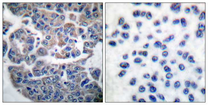 EEF2K Antibody - Immunohistochemistry analysis of paraffin-embedded human breast carcinoma, using eEF2K (Phospho-Ser366) Antibody. The picture on the right is blocked with the phospho peptide.
