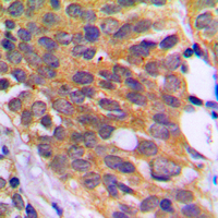 EEF2K Antibody - Immunohistochemical analysis of EEF2K (pS366) staining in human prostate cancer formalin fixed paraffin embedded tissue section. The section was pre-treated using heat mediated antigen retrieval with sodium citrate buffer (pH 6.0). The section was then incubated with the antibody at room temperature and detected using an HRP conjugated compact polymer system. DAB was used as the chromogen. The section was then counterstained with hematoxylin and mounted with DPX.