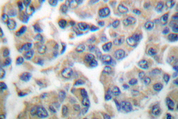 EEF2K Antibody - IHC of eEF2K (P360) pAb in paraffin-embedded human breast carcinoma tissue.