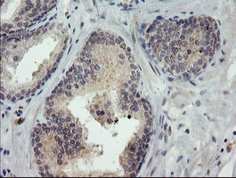 EEYORE / TIGD1 Antibody - IHC of paraffin-embedded Carcinoma of Human prostate tissue using anti-TIGD1 mouse monoclonal antibody. (Heat-induced epitope retrieval by 10mM citric buffer, pH6.0, 100C for 10min).