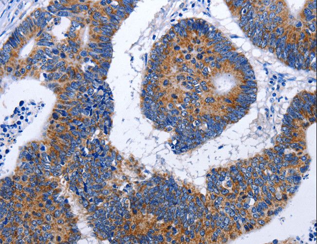 EF1G / EEF1G Antibody - Immunohistochemistry of paraffin-embedded Human colon cancer using EEF1G Polyclonal Antibody at dilution of 1:50.