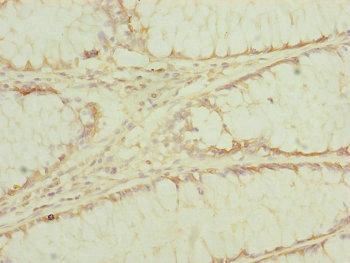 EF1G / EEF1G Antibody - Immunohistochemistry of paraffin-embedded human colon cancer at dilution of 1:100