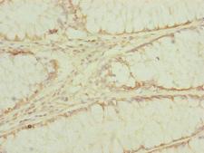 EF1G / EEF1G Antibody - Immunohistochemistry of paraffin-embedded human colon cancer at dilution of 1:100