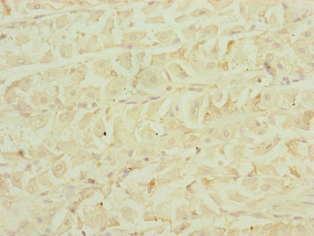 EF1G / EEF1G Antibody - Immunohistochemistry of paraffin-embedded human gastric cancer at dilution of 1:100