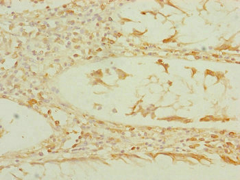 EF1G / EEF1G Antibody - Immunohistochemistry of paraffin-embedded human colon cancer at dilution of 1:100