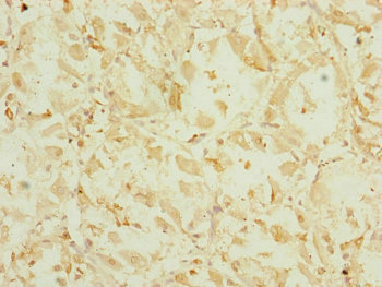 EF1G / EEF1G Antibody - Immunohistochemistry of paraffin-embedded human gastric cancer at dilution of 1:100
