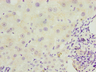 EFCAB12 / C3orf25 Antibody - Immunohistochemistry of paraffin-embedded human liver cancer using EFCAB12 Antibody at dilution of 1:100