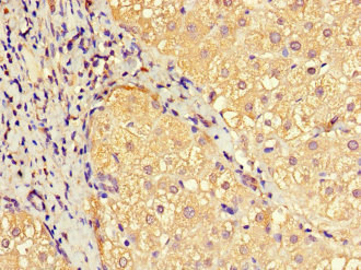 EFCAB7 Antibody - Immunohistochemistry of paraffin-embedded human liver cancer at dilution 1:100